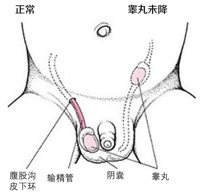 “天生”僅一個睾丸該怎麽辦？