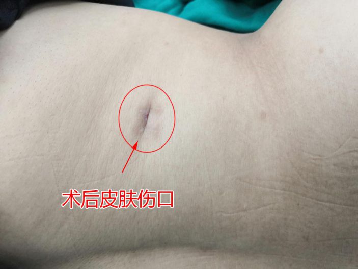 複雜性腎結石還可以這樣治 ——外一科B超定位一孔取多石